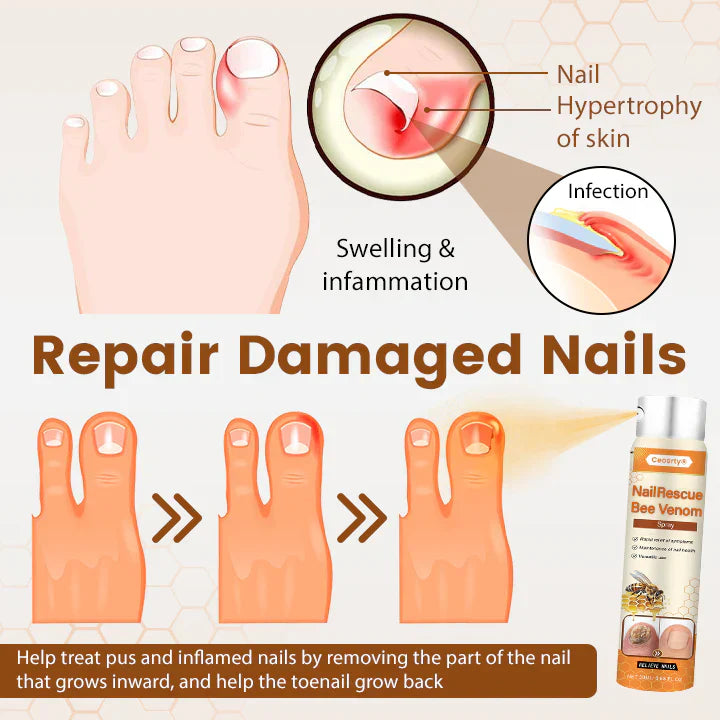 [CLEARANCE SALE] Crucial® NailRescue Bee Venom Spray | Rs. 999/- & Rs. 150/- Delivery Charges